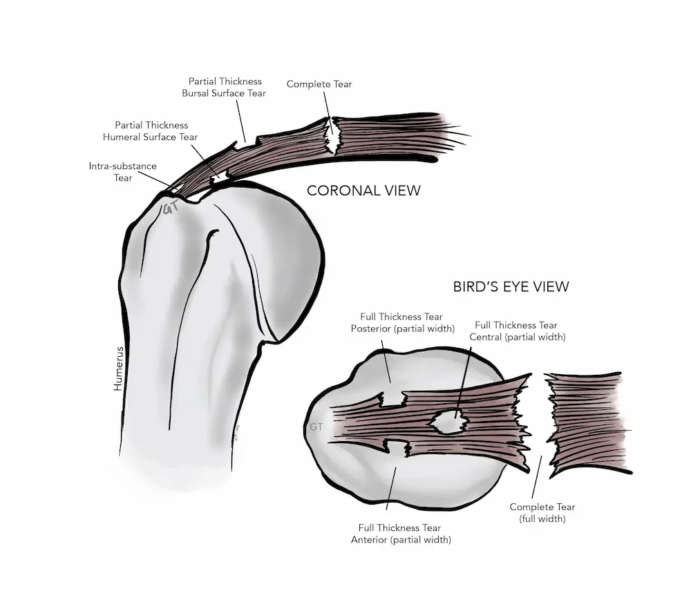 Glenorie Health Rotator Cuff Tears